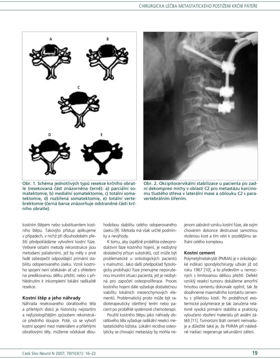 totální vertebrektomie (černá barva znázorňuje odstraněné části krčního obratle). Obr. 2.