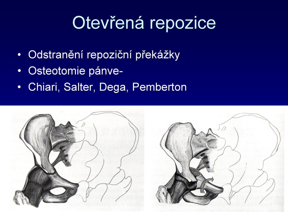 pánve- Chiari, Salter, Dega,