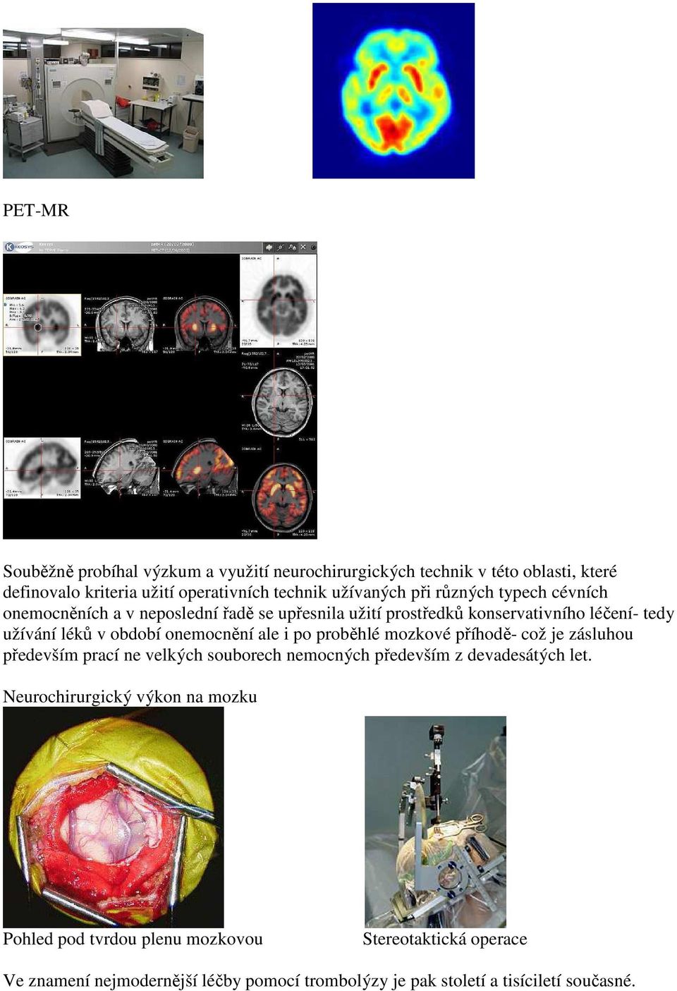 onemocnění ale i po proběhlé mozkové příhodě- což je zásluhou především prací ne velkých souborech nemocných především z devadesátých let.