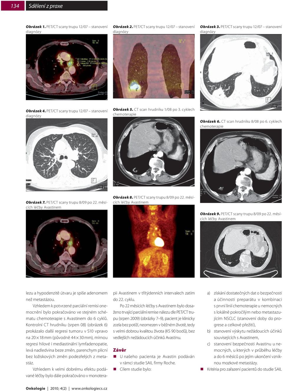 měsících Obrázek 8. PET/CT scany trupu 8/09 po 22. měsících Obrázek 9. PET/CT scany trupu 8/09 po 22. měsících lezu a hypodenzitě útvaru je spíše adenomem než metastázou.