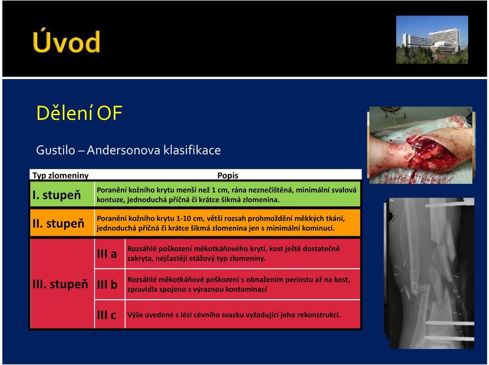 Poranění kožního krytu 1-10 cm, větší rozsah prohmoždění měkkých tkání, jednoduchá příčná či krátce šikmá zlomenina jen s minimální kominucí. III.