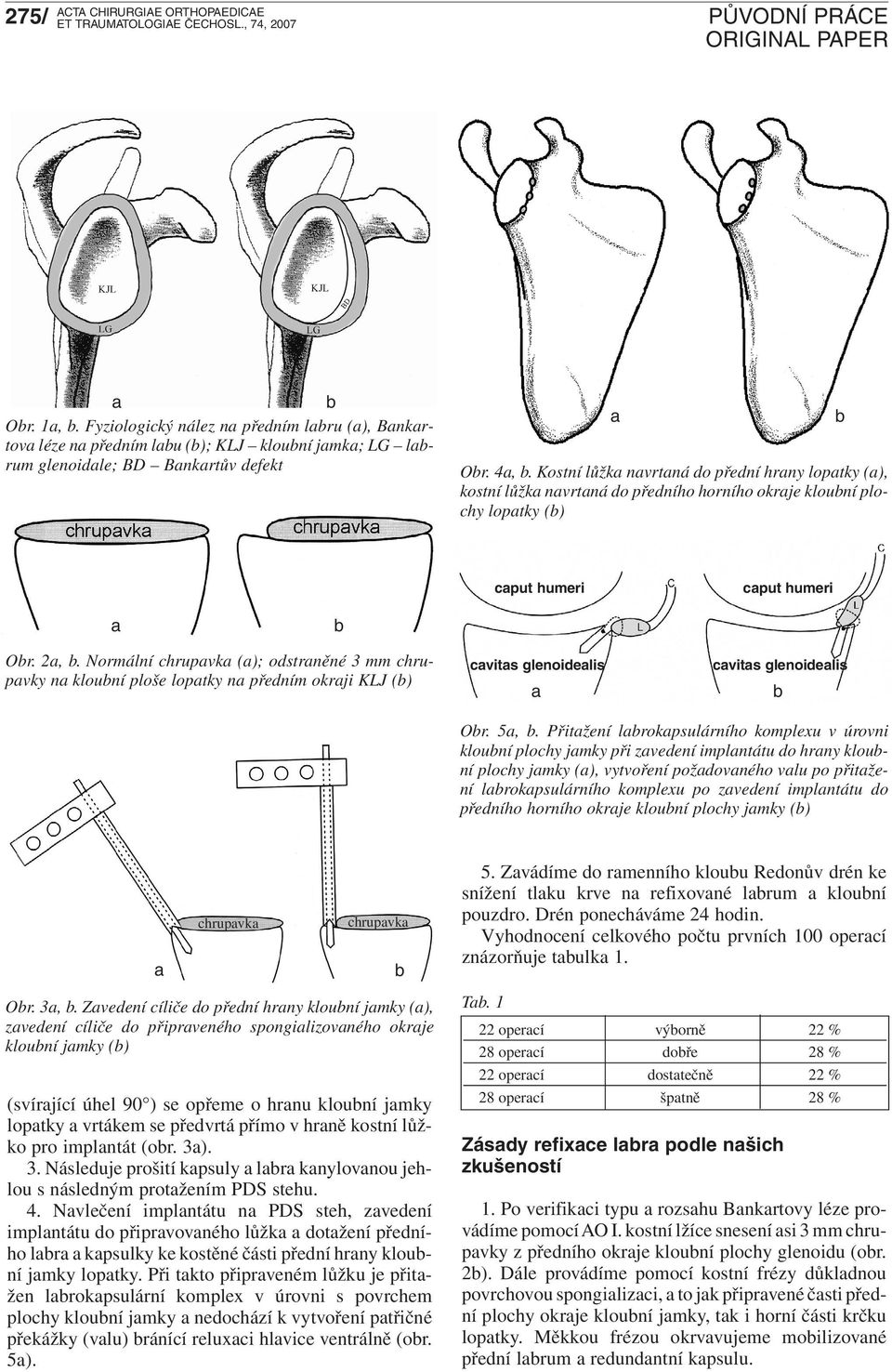 Normální chrupvk (); odstrněné 3 mm chrupvky n klouní ploše loptky n předním okrji KLJ () cvits glenoidelis cvits glenoidelis Or. 5,.