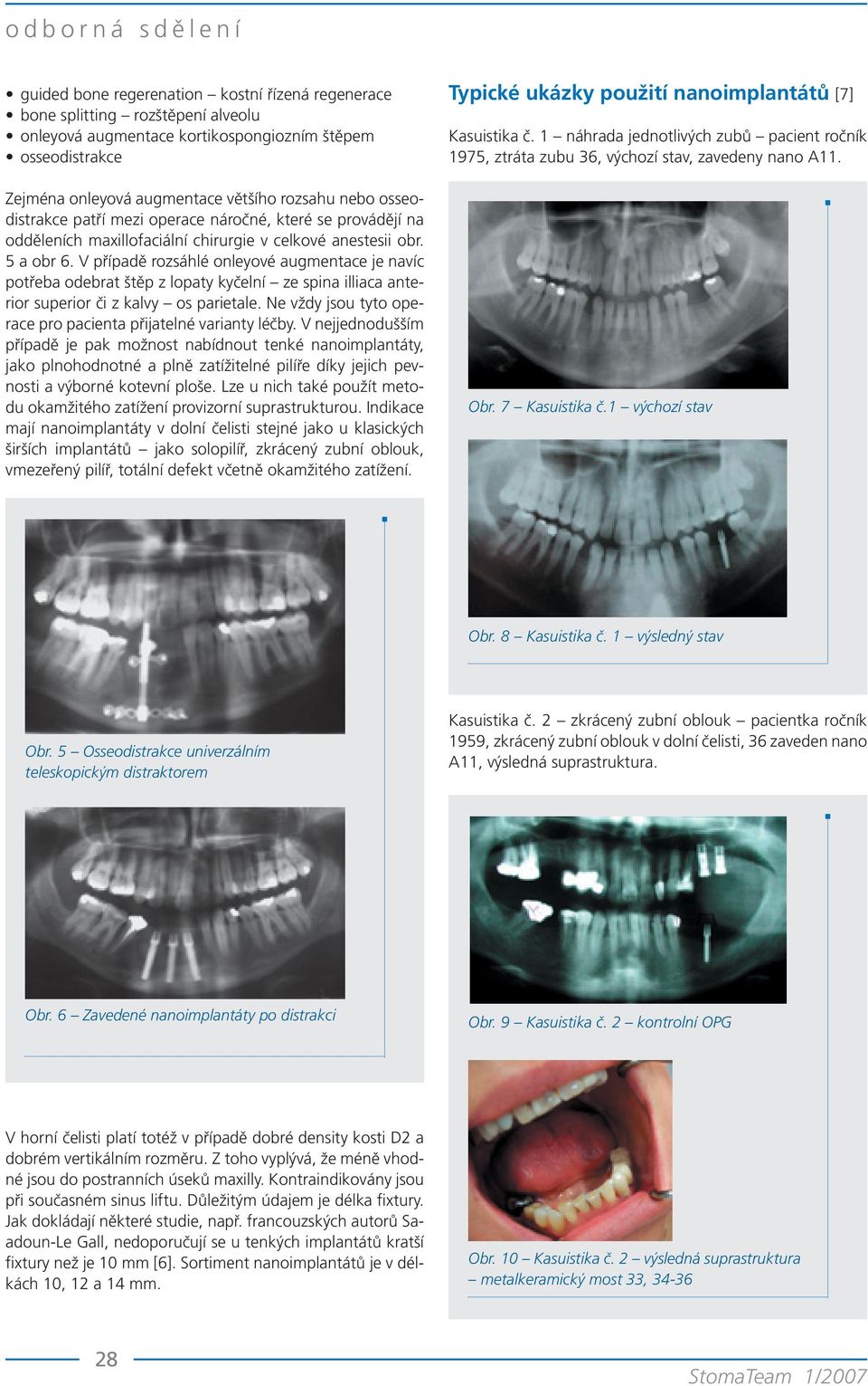 V případě rozsáhlé onleyové augmentace je navíc potřeba odebrat štěp z lopaty kyčelní ze spina illiaca anterior superior či z kalvy os parietale.