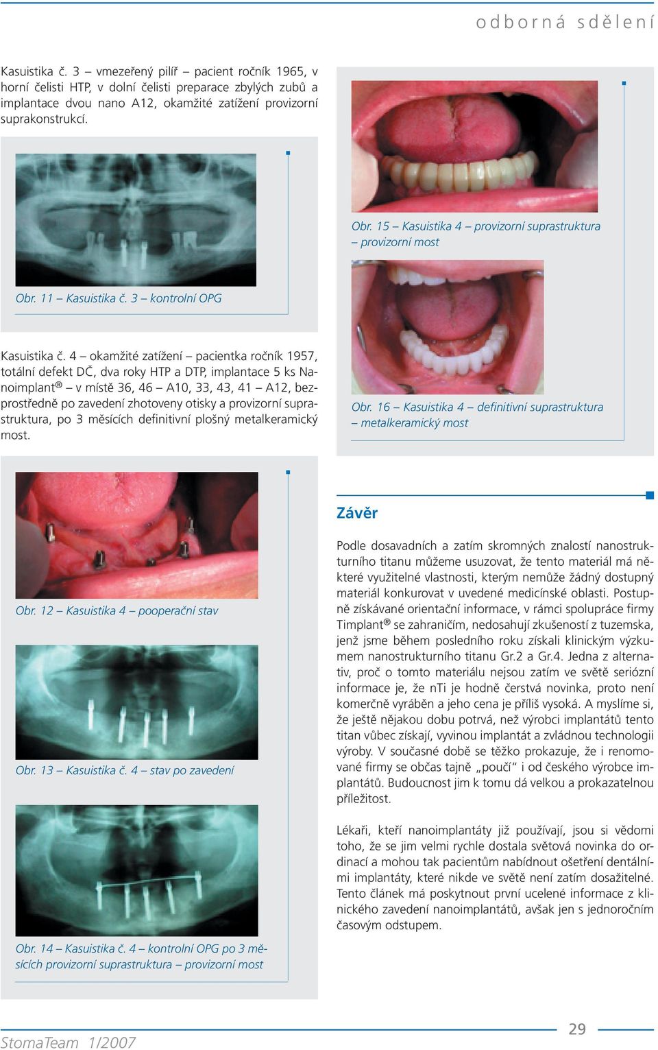 4 okamžité zatížení pacientka ročník 1957, totální defekt DČ, dva roky HTP a DTP, implantace 5 ks Nanoimplant v místě 36, 46 A10, 33, 43, 41 A12, bezprostředně po zavedení zhotoveny otisky a