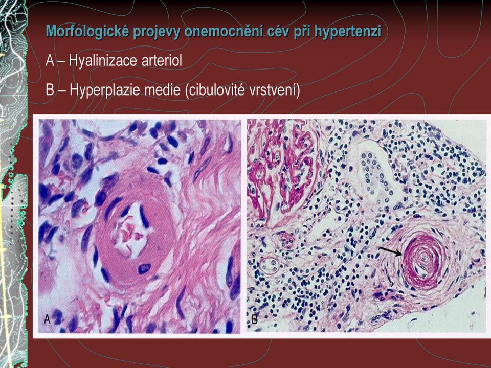 hypertenzi A Hyalinizace