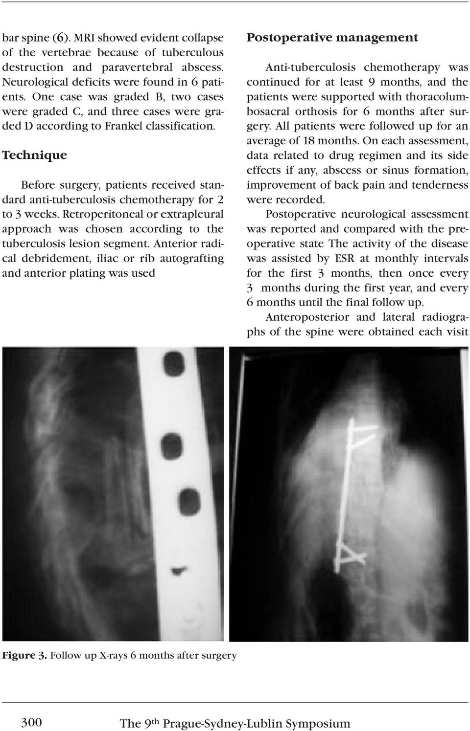 Technique Before surgery, patients received standard anti-tuberculosis chemotherapy for 2 to 3 weeks. Retroperitoneal or extrapleural approach was chosen according to the tuberculosis lesion segment.