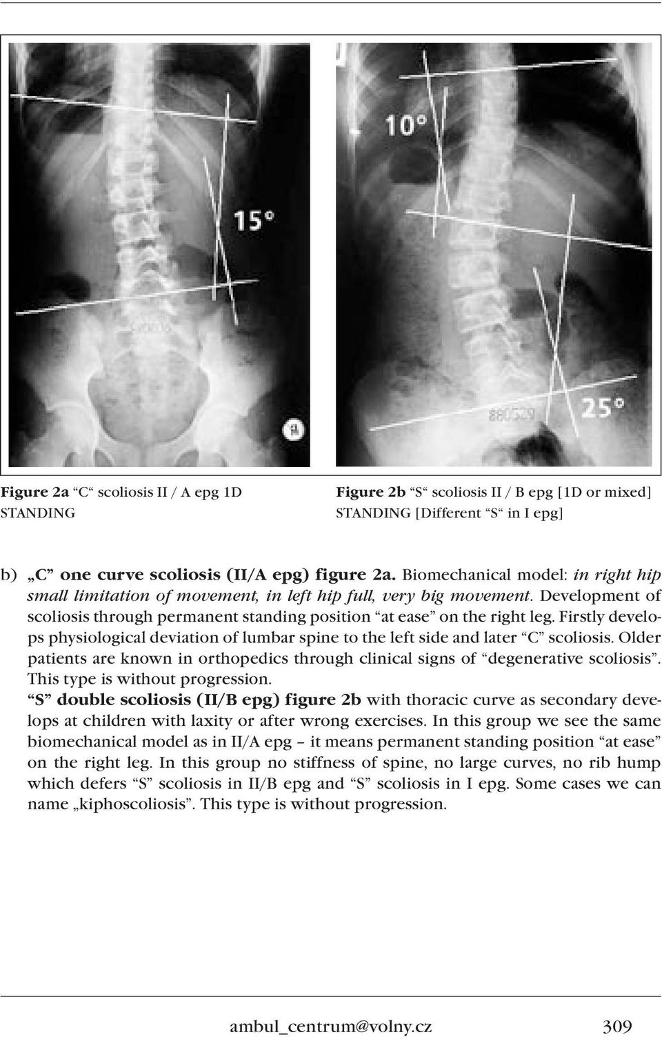 Firstly develops physiological deviation of lumbar spine to the left side and later C scoliosis. Older patients are known in orthopedics through clinical signs of degenerative scoliosis.