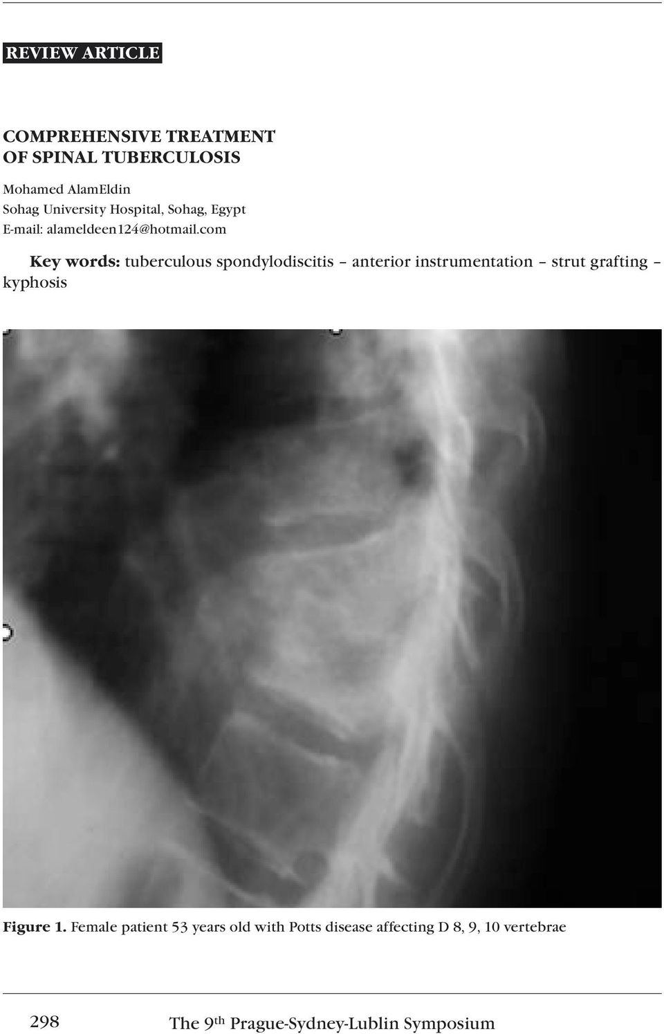com Key words: tuberculous spondylodiscitis anterior instrumentation strut grafting kyphosis