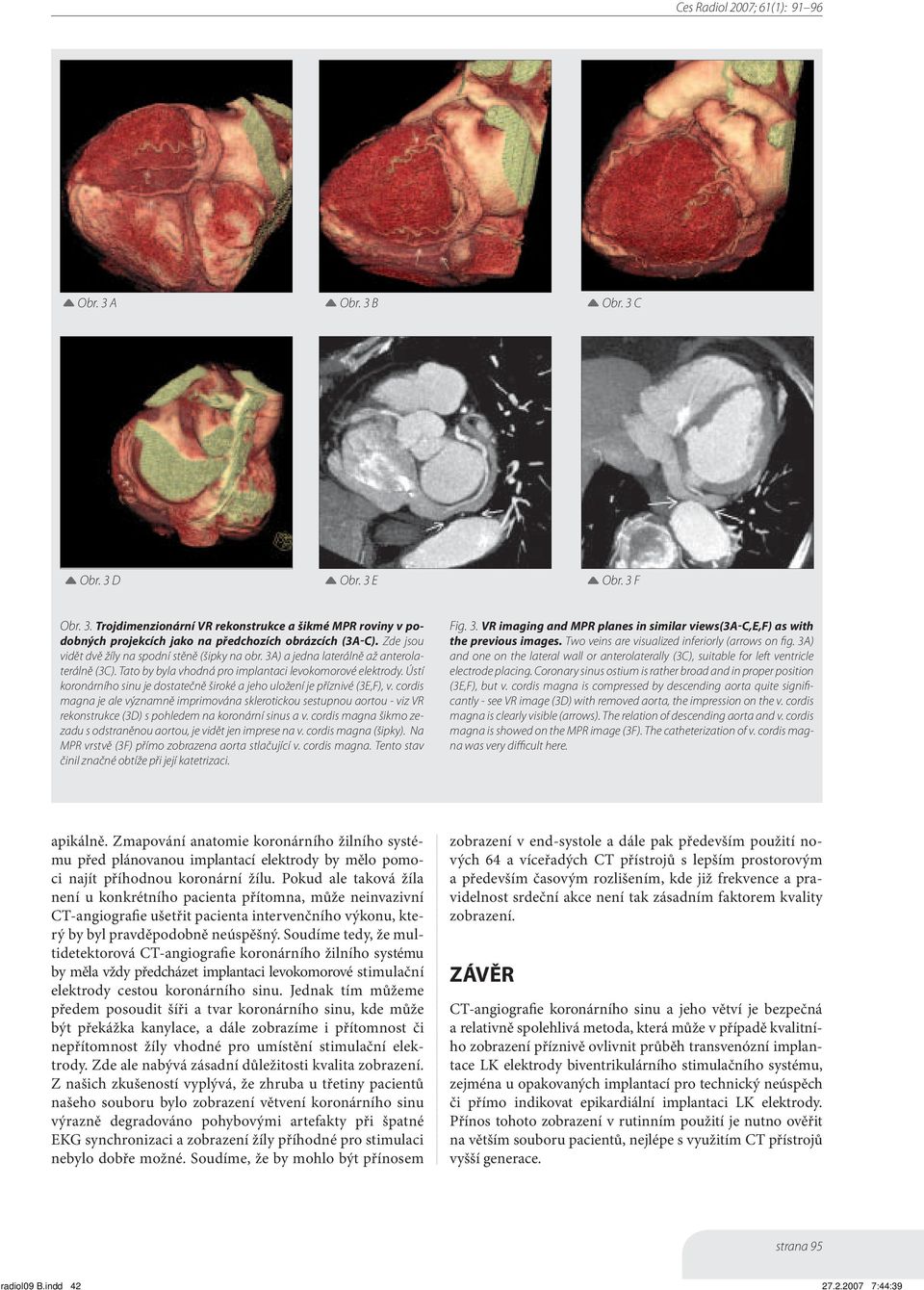 Ústí koronárního sinu je dostatečně široké a jeho uložení je příznivé (3E,F), v.