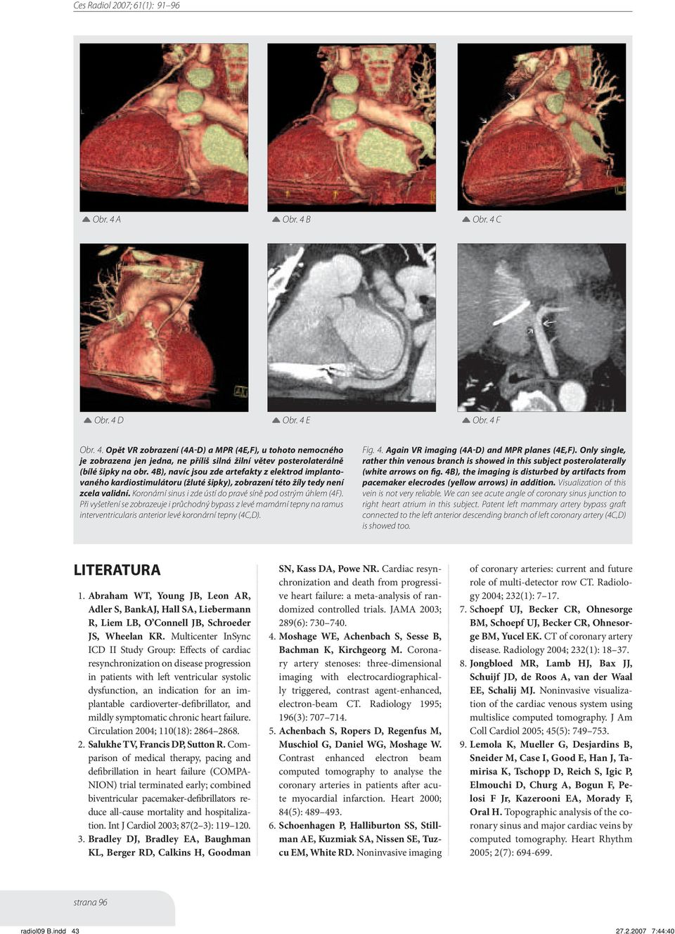 Při vyšetření se zobrazeuje i průchodný bypass z levé mamární tepny na ramus interventricularis anterior levé koronární tepny (4C,D). Fig. 4. Again VR imaging (4A-D) and MPR planes (4E,F).