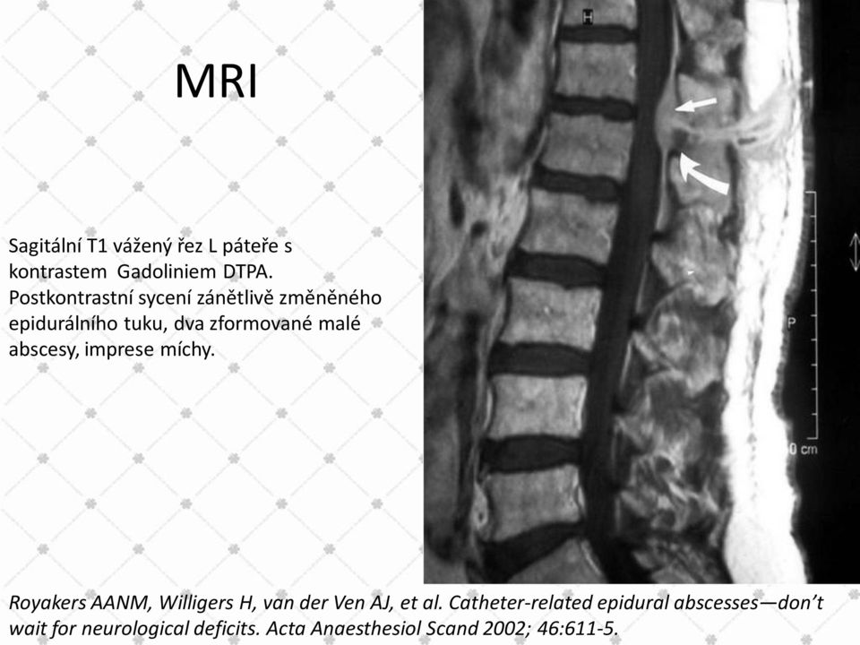 abscesy, imprese míchy. Royakers AANM, Willigers H, van der Ven AJ, et al.