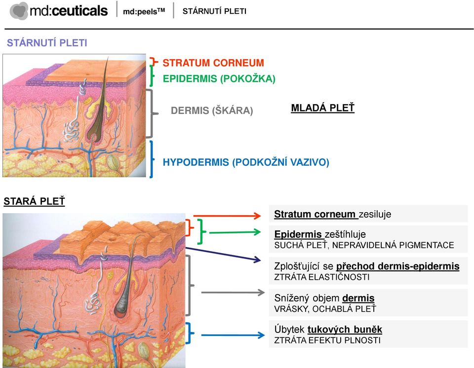 zeštíhluje SUCHÁ PLEŤ, NEPRAVIDELNÁ PIGMENTACE Zplošťující se přechod dermis-epidermis