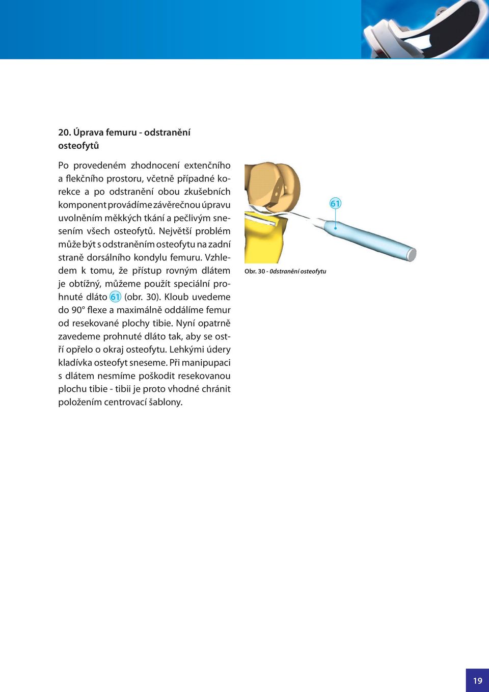 Vzhledem k tomu, že přístup rovným dlátem je obtížný, můžeme použít speciální prohnuté dláto 61 25 (obr. 30). Kloub uvedeme do 90 flexe a maximálně oddálíme femur od resekované plochy tibie.