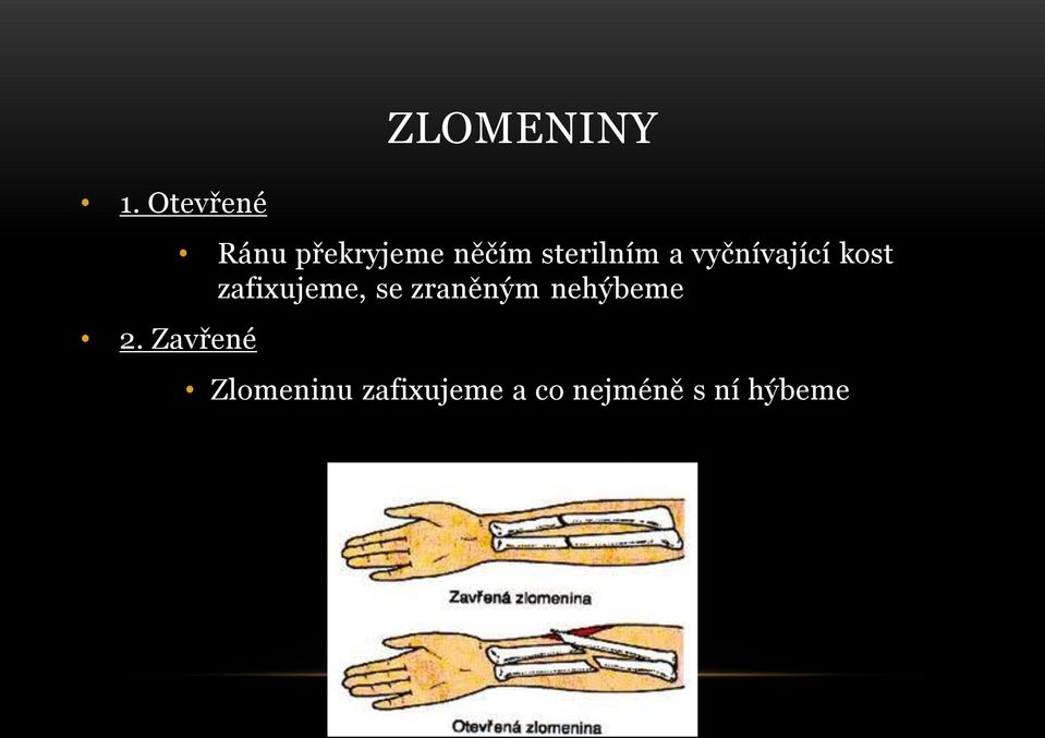 sterilním a vyčnívající kost zafixujeme,