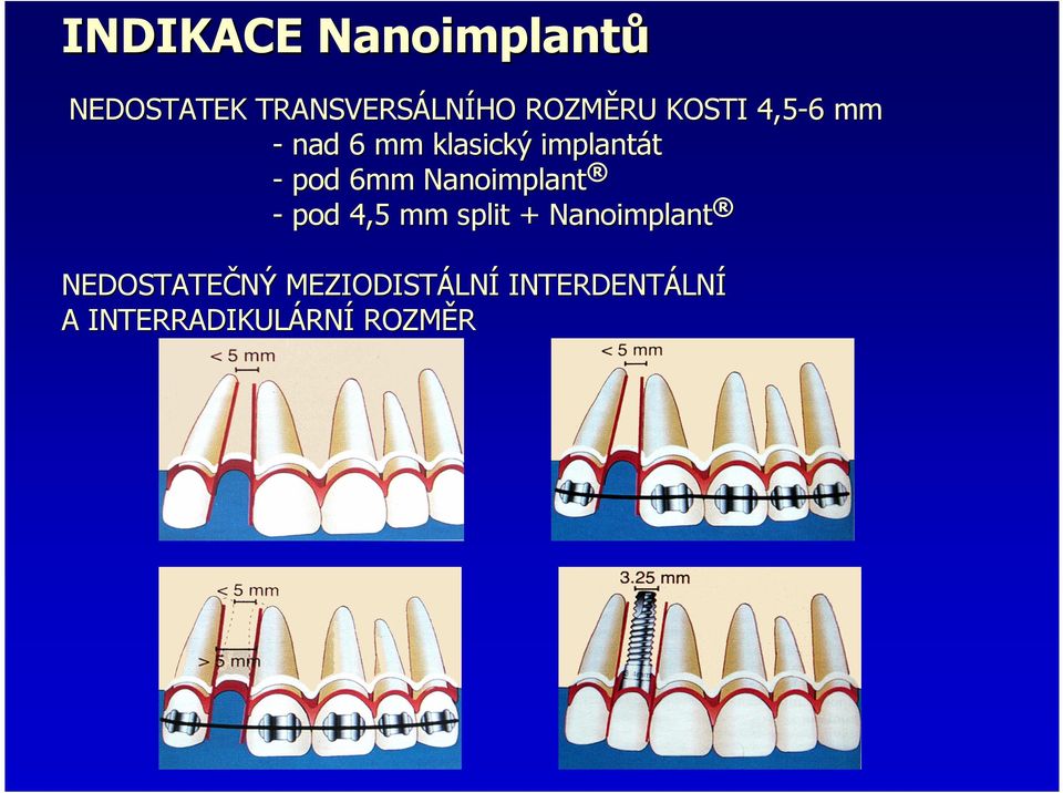 Nanoimplant - pod 4,5 mm split + Nanoimplant