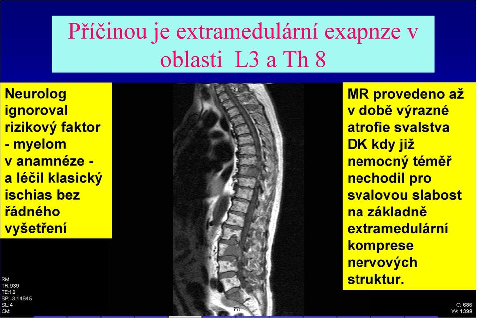 vyšetření MR provedeno až v době výrazné atrofie svalstva DK kdy již nemocný