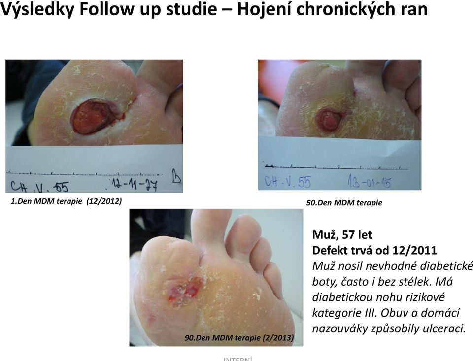 Den MDM terapie (2/2013) Muž, 57 let Defekt trvá od 12/2011 Muž nosil