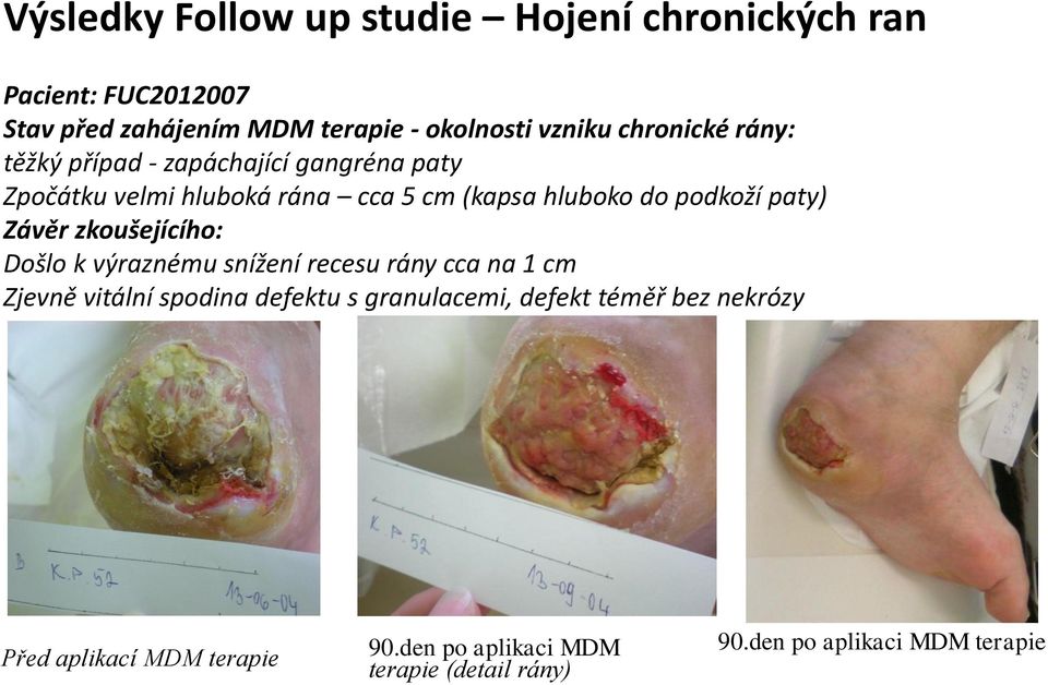 paty) Závěr zkoušejícího: Došlo k výraznému snížení recesu rány cca na 1 cm Zjevně vitální spodina defektu s granulacemi,