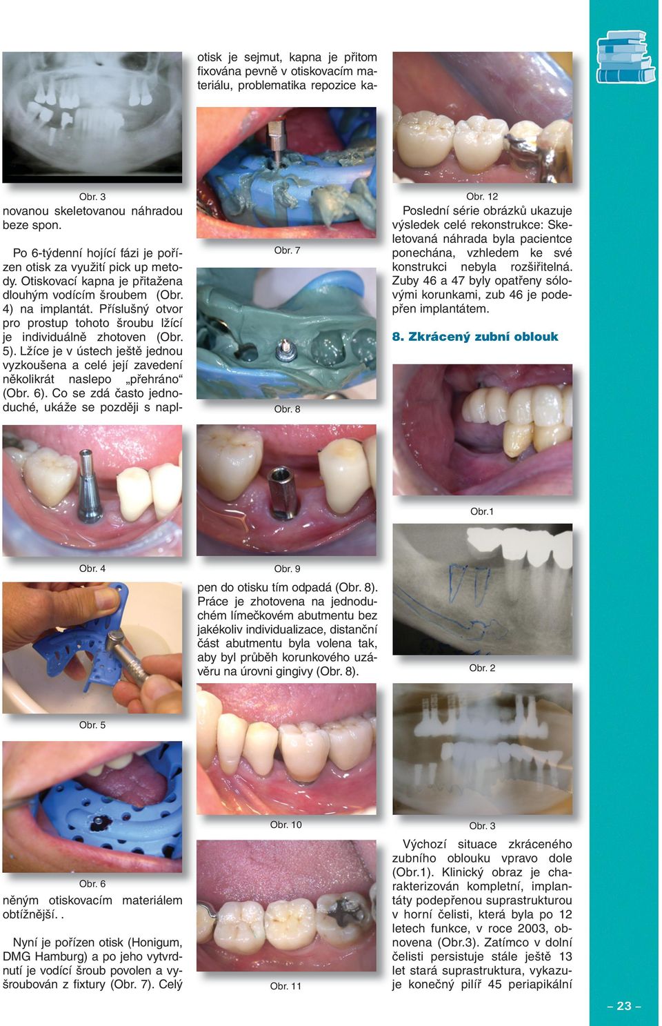 Zuby 46 a 47 byly opatřeny sólovými korunkami, zub 46 je podepřen implantátem. 8. Zkrácený zubní oblouk Obr.1 Obr. 4 Obr.