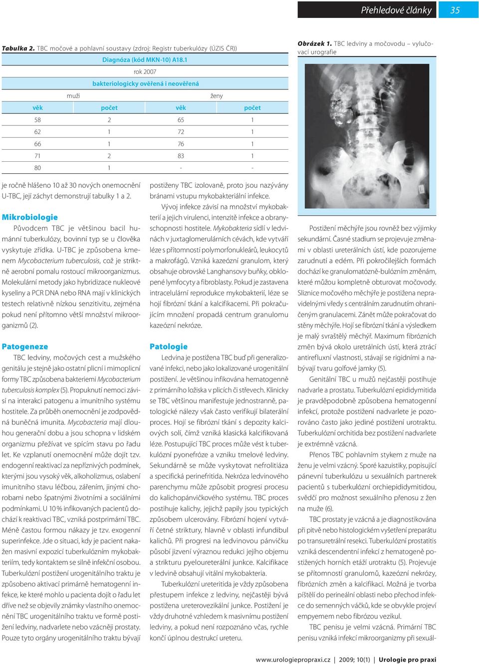 TBC ledviny a močovodu vylučovací urografie je ročně hlášeno 10 až 30 nových onemocnění U-TBC, její záchyt demonstrují tabulky 1 a 2.