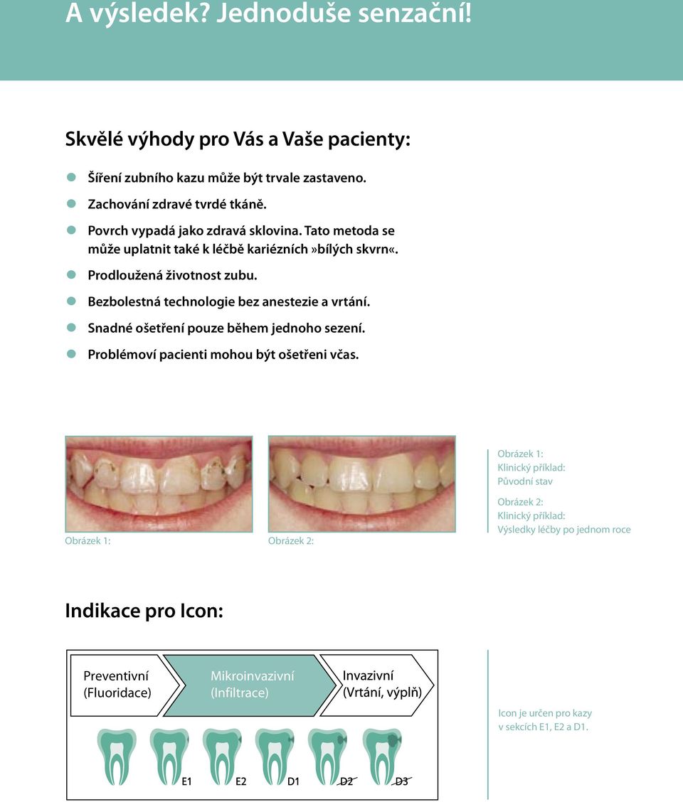 Bezbolestná technologie bez anestezie a vrtání. Snadné ošetření pouze během jednoho sezení. Problémoví pacienti mohou být ošetřeni včas.
