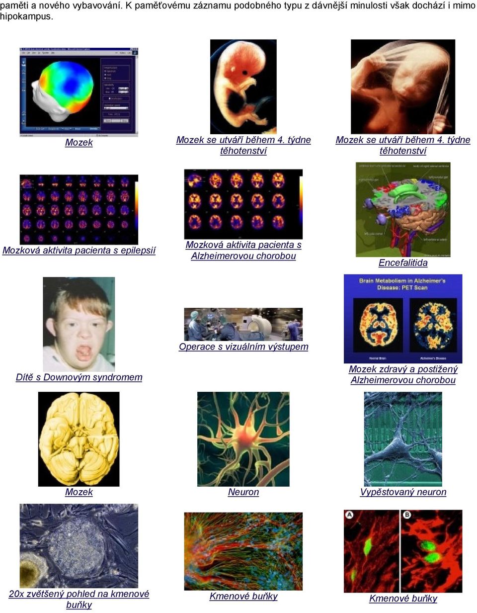 týdne těhotenství Mozková aktivita pacienta s epilepsií Mozková aktivita pacienta s Alzheimerovou chorobou Encefalitida Dítě s