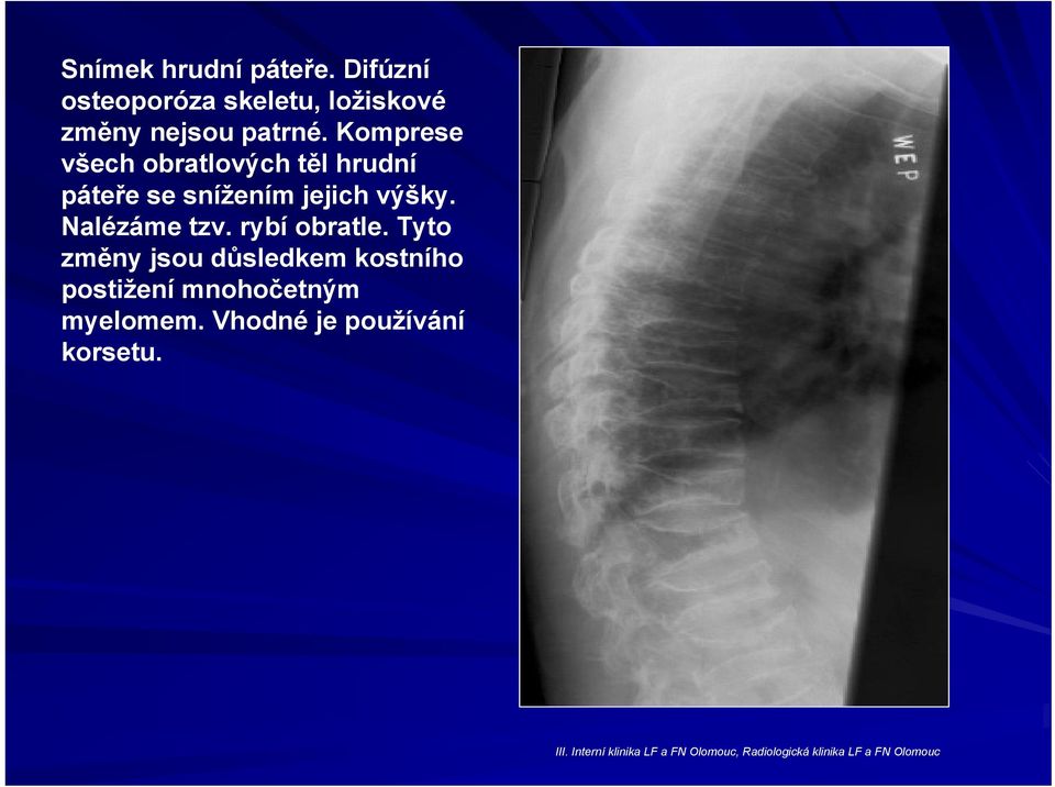 rybí obratle. Tyto změny jsou důsledkem kostního postižení mnohočetným myelomem.