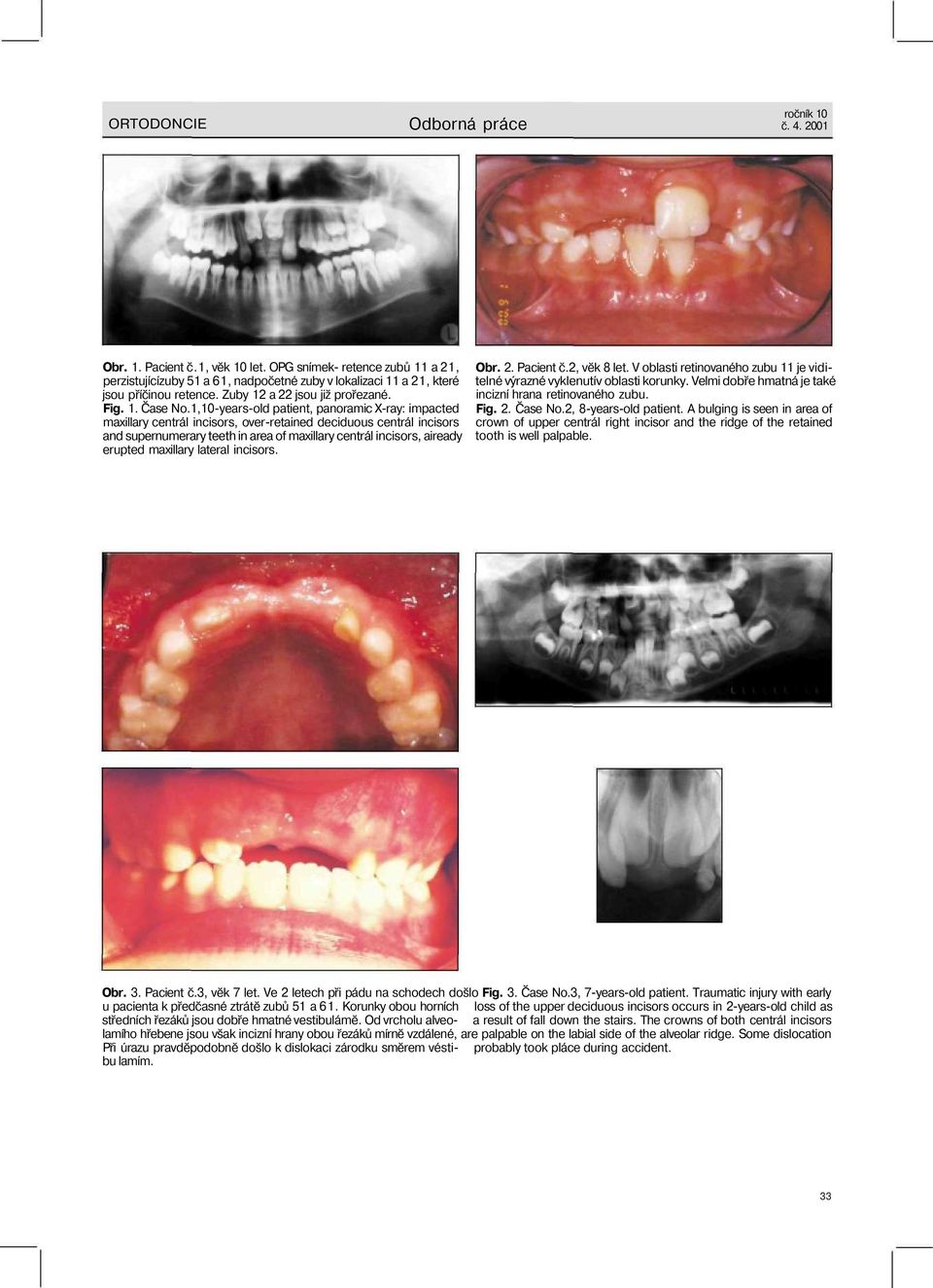 1,10-years-old patient, panoramic X-ray: impacted maxillary centrál incisors, over-retained deciduous centrál incisors and supernumerary teeth in area of maxillary centrál incisors, aiready erupted