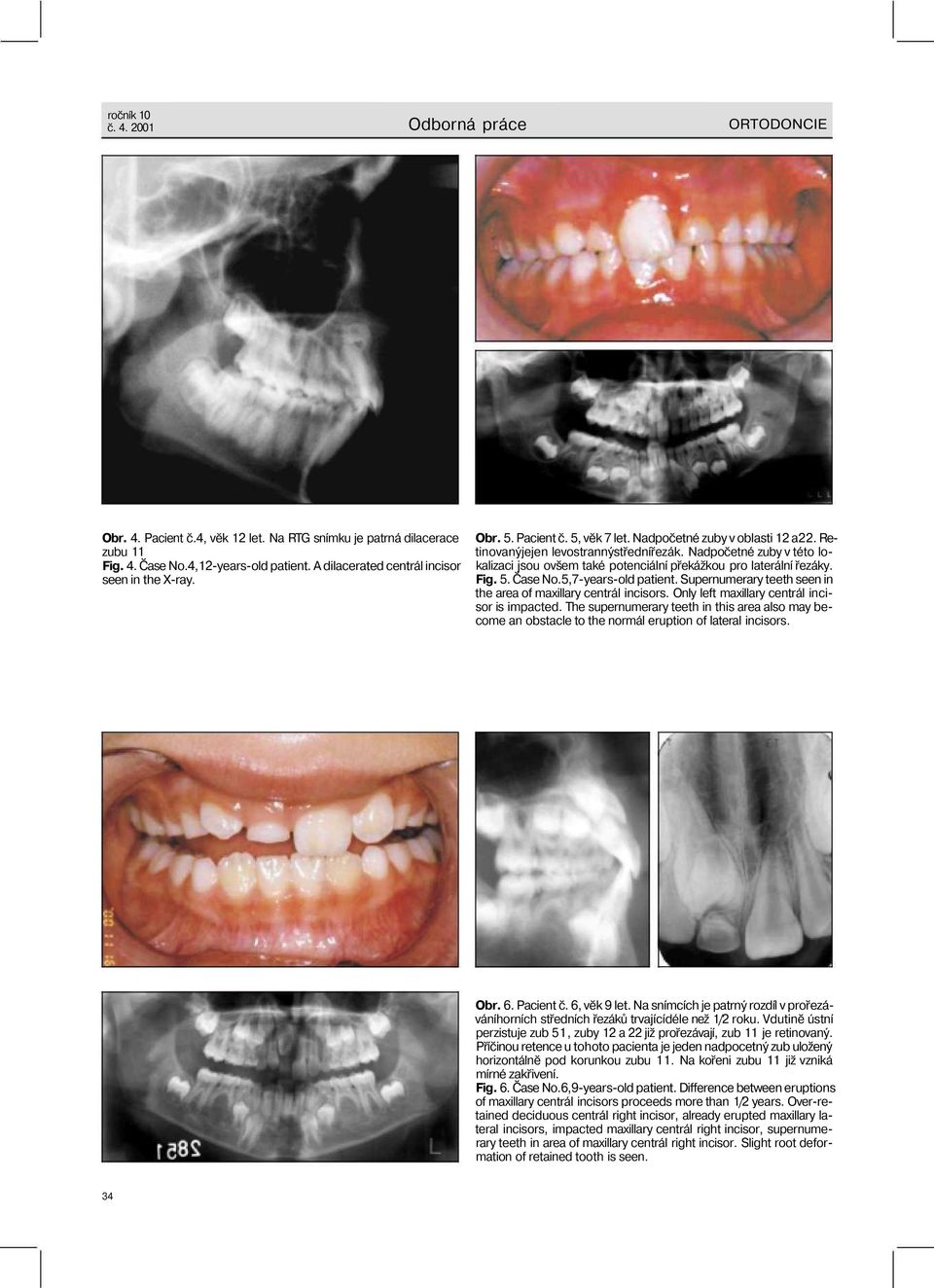 Nadpočetné zuby v této lokalizaci jsou ovšem také potenciální překážkou pro laterální řezáky. Fig. 5. Čase No.5,7-years-old patient. Supernumerary teeth seen in the area of maxillary centrál incisors.