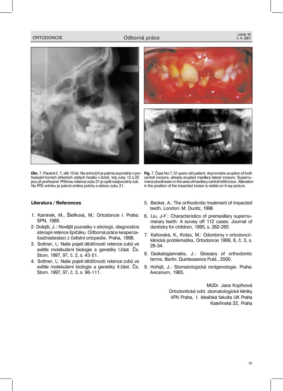 Na RTG snímku je patrná změna polohy a sklonu zubu 21. Fig. 7. Čase No.7,12-years-old patient. Asymmetric eruption of both centrál incisors, already erupted maxillary lateral incisors.