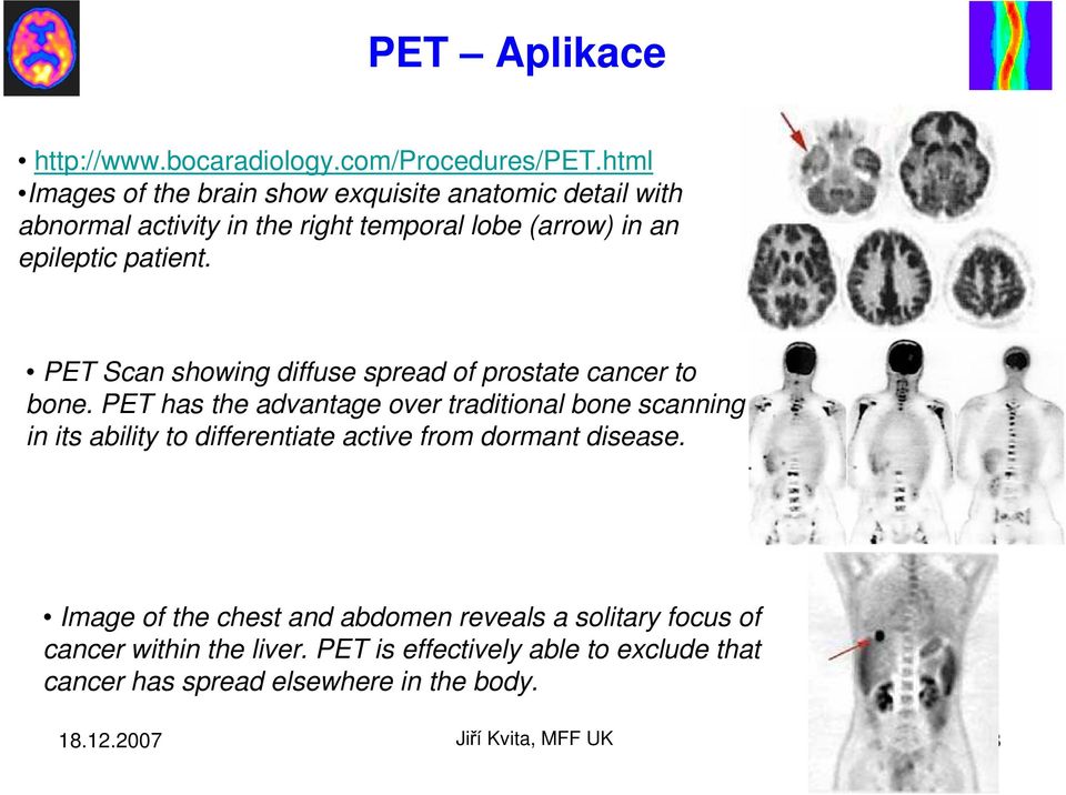 patient. PET Scan showing diffuse spread of prostate cancer to bone.