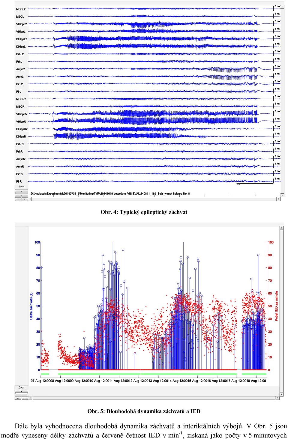 dlouhodobá dynamika záchvatů a interiktálních výbojů. V Obr.
