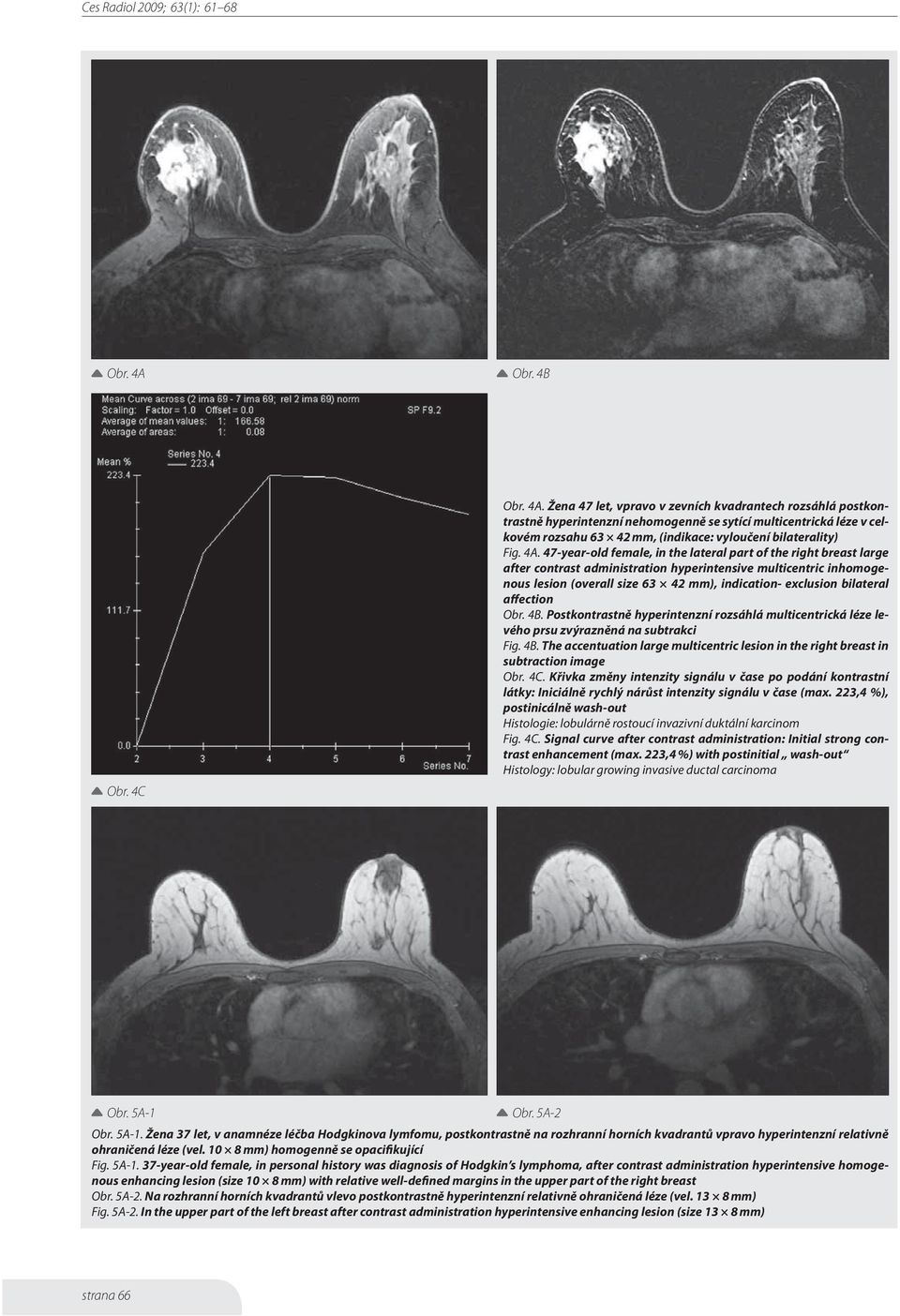 bilateral affection Obr. 4B. Postkontrastně hyperintenzní rozsáhlá multicentrická léze levého prsu zvýrazněná na subtrakci Fig. 4B. The accentuation large multicentric lesion in the right breast in subtraction image Obr.