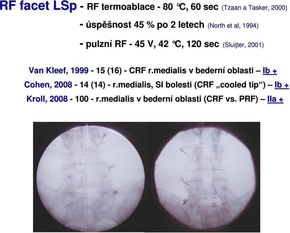 Kleef,, 1999-15 (16) - CRF r.medialis v bederní oblasti Ib + Cohen,, 2008-14 (14) - r.