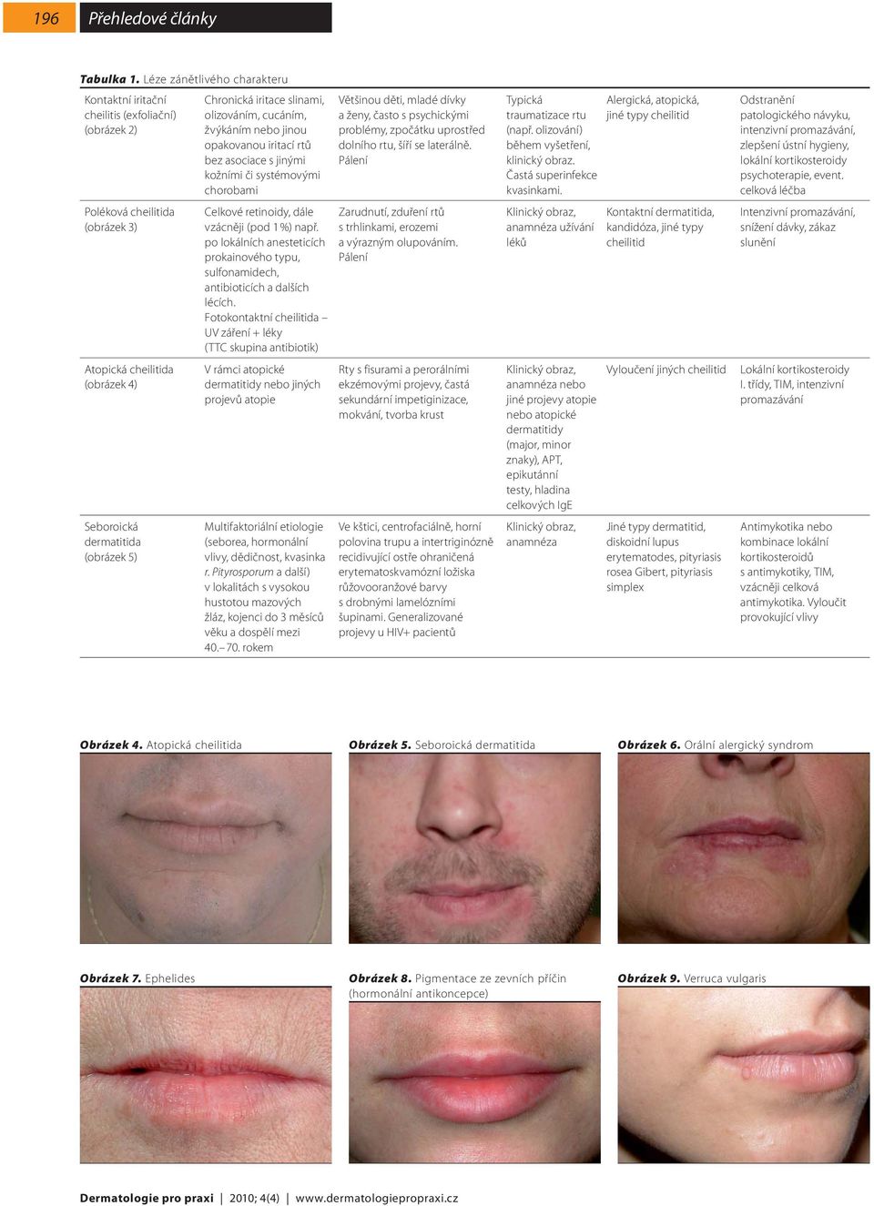 slinami, olizováním, cucáním, žvýkáním nebo jinou opakovanou iritací rtů bez asociace s jinými kožními či systémovými chorobami Celkové retinoidy, dále vzácněji (pod 1 %) např.