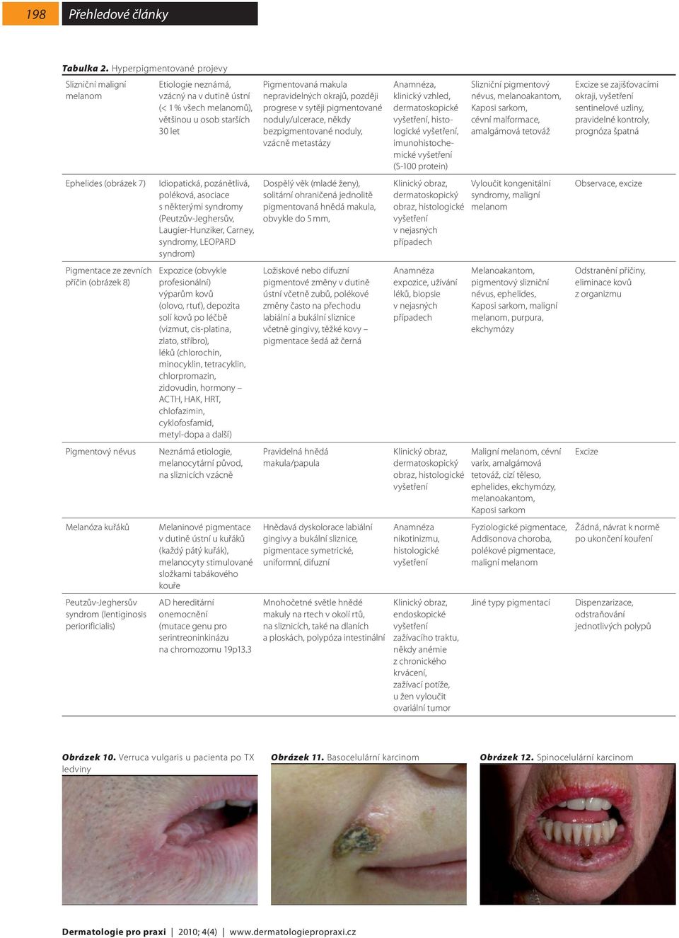 periorificialis) Etiologie neznámá, vzácný na v dutině ústní (< 1 % všech melanomů), většinou u osob starších 30 let Idiopatická, pozánětlivá, poléková, asociace s některými syndromy
