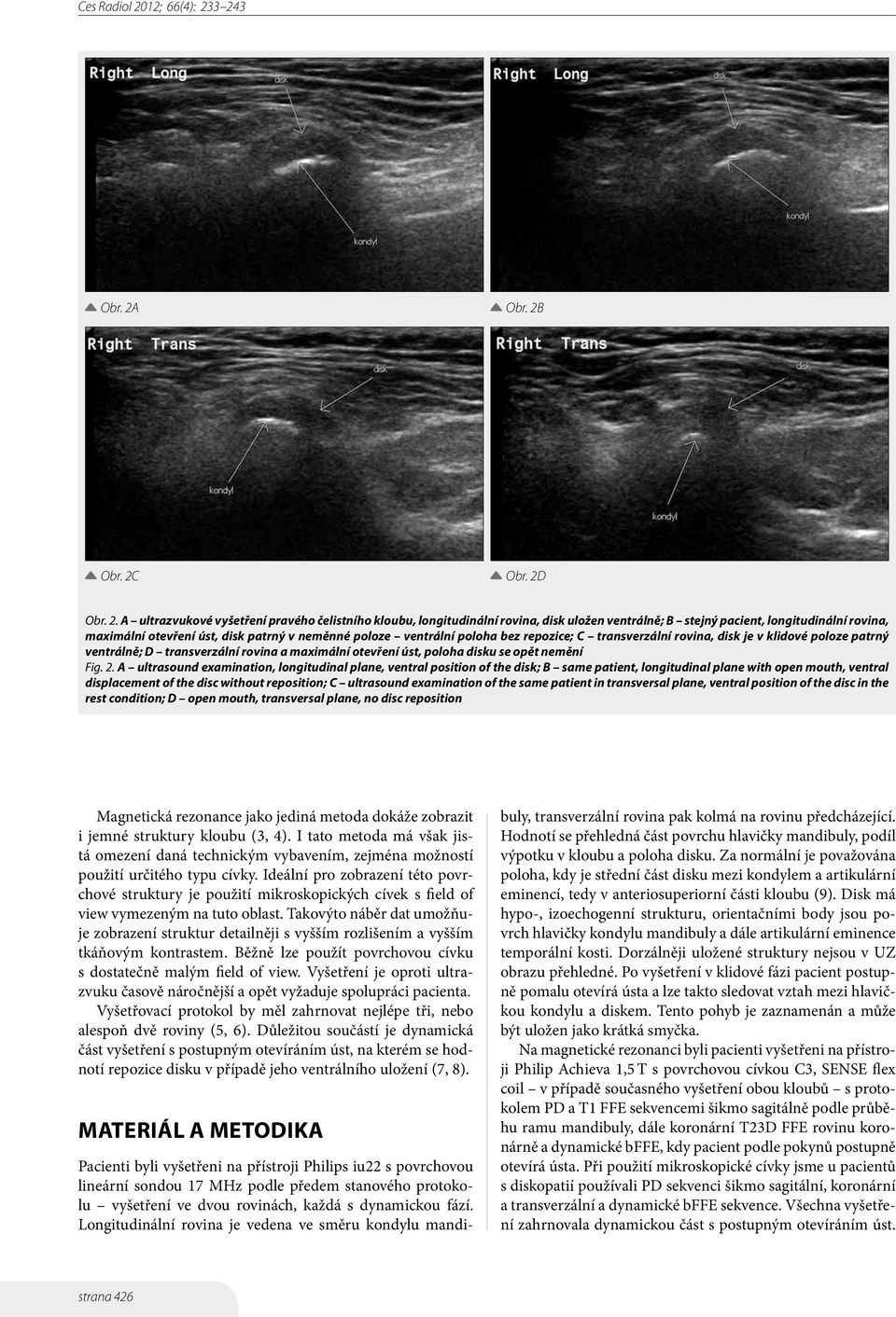 3 243 Obr. 2A Obr. 2B Obr. 2C Obr. 2D Obr. 2. A ultrazvukové vyšetření pravého čelistního kloubu, longitudinální rovina, disk uložen ventrálně; B stejný pacient, longitudinální rovina, maximální