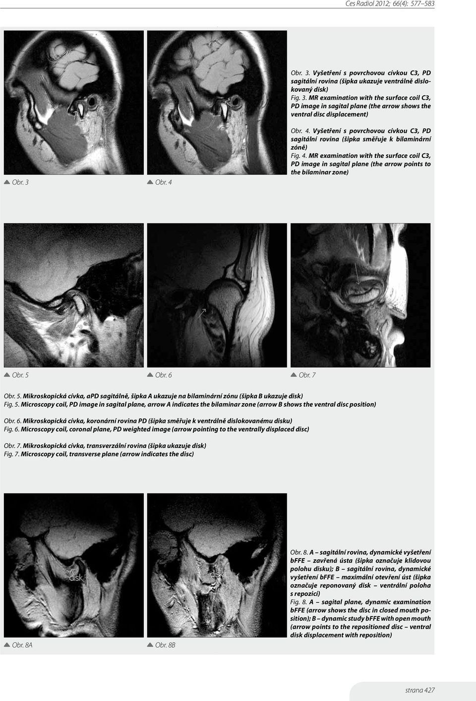 5 Obr. 6 Obr. 7 Obr. 5. Mikroskopická cívka, apd sagitálně, šipka A ukazuje na bilaminární zónu (šipka B ukazuje disk) Fig. 5. Microscopy coil, PD image in sagital plane, arrow A indicates the bilaminar zone (arrow B shows the ventral disc position) Obr.