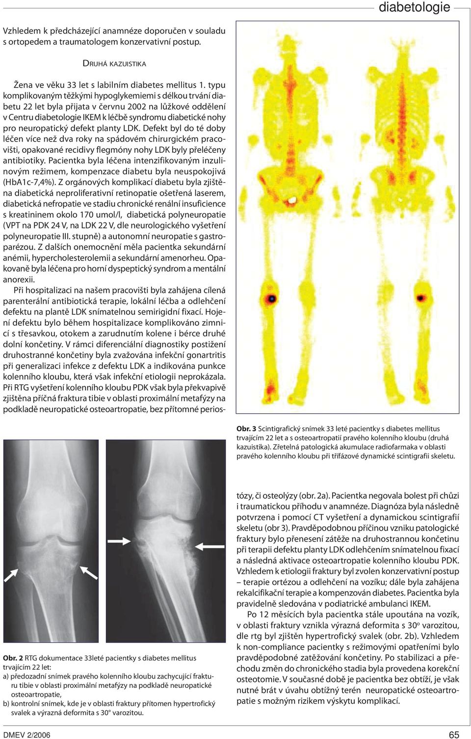 Zřetelná patologická akumulace radiofarmaka v oblasti pravého kolenního kloubu při třífázové dynamické scintigrafii skeletu. Obr.