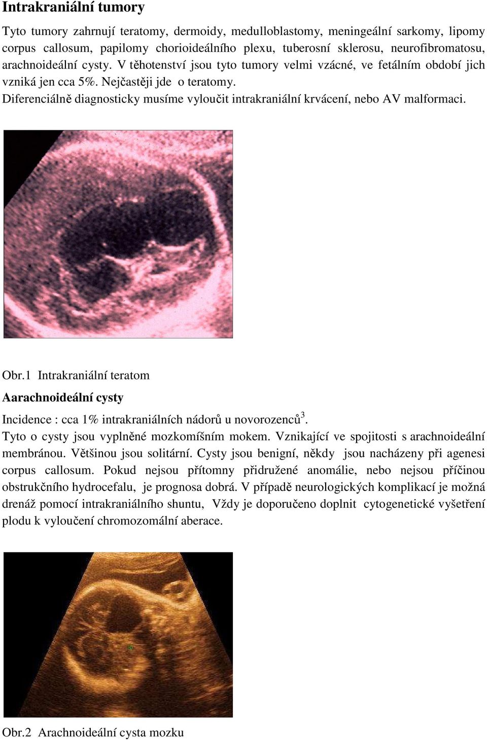 Diferenciálně diagnosticky musíme vyloučit intrakraniální krvácení, nebo AV malformaci. Obr.1 Intrakraniální teratom Aarachnoideální cysty Incidence : cca 1% intrakraniálních nádorů u novorozenců 3.