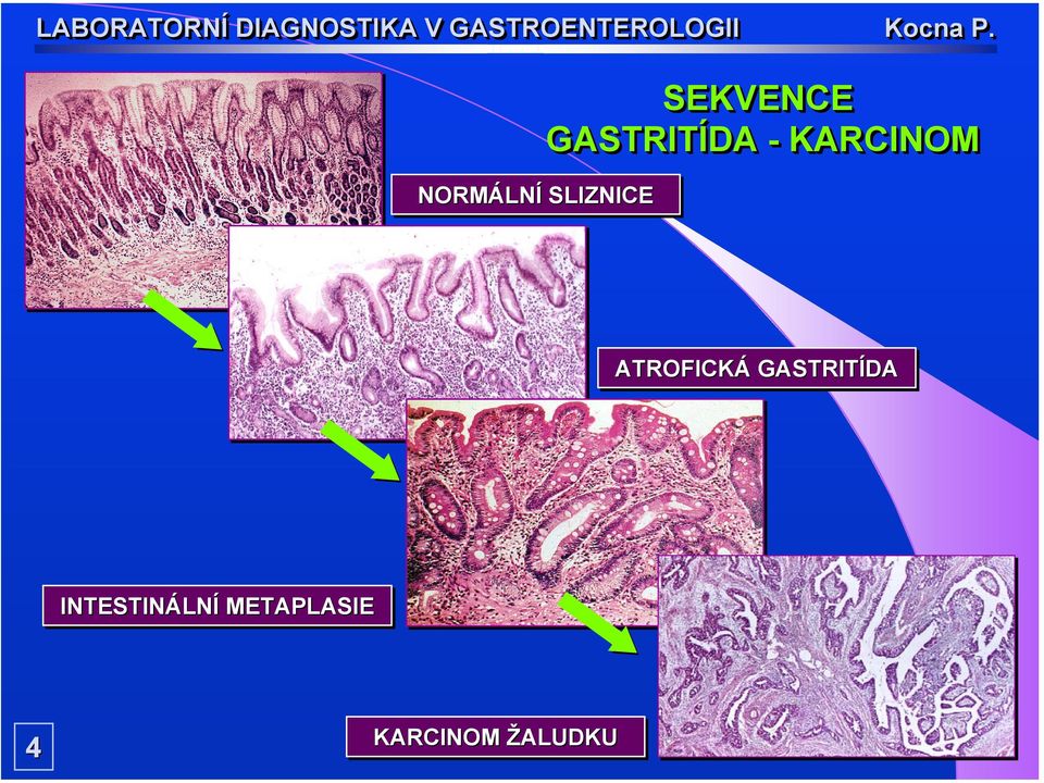 ATROFICKÁ GASTRITÍDA