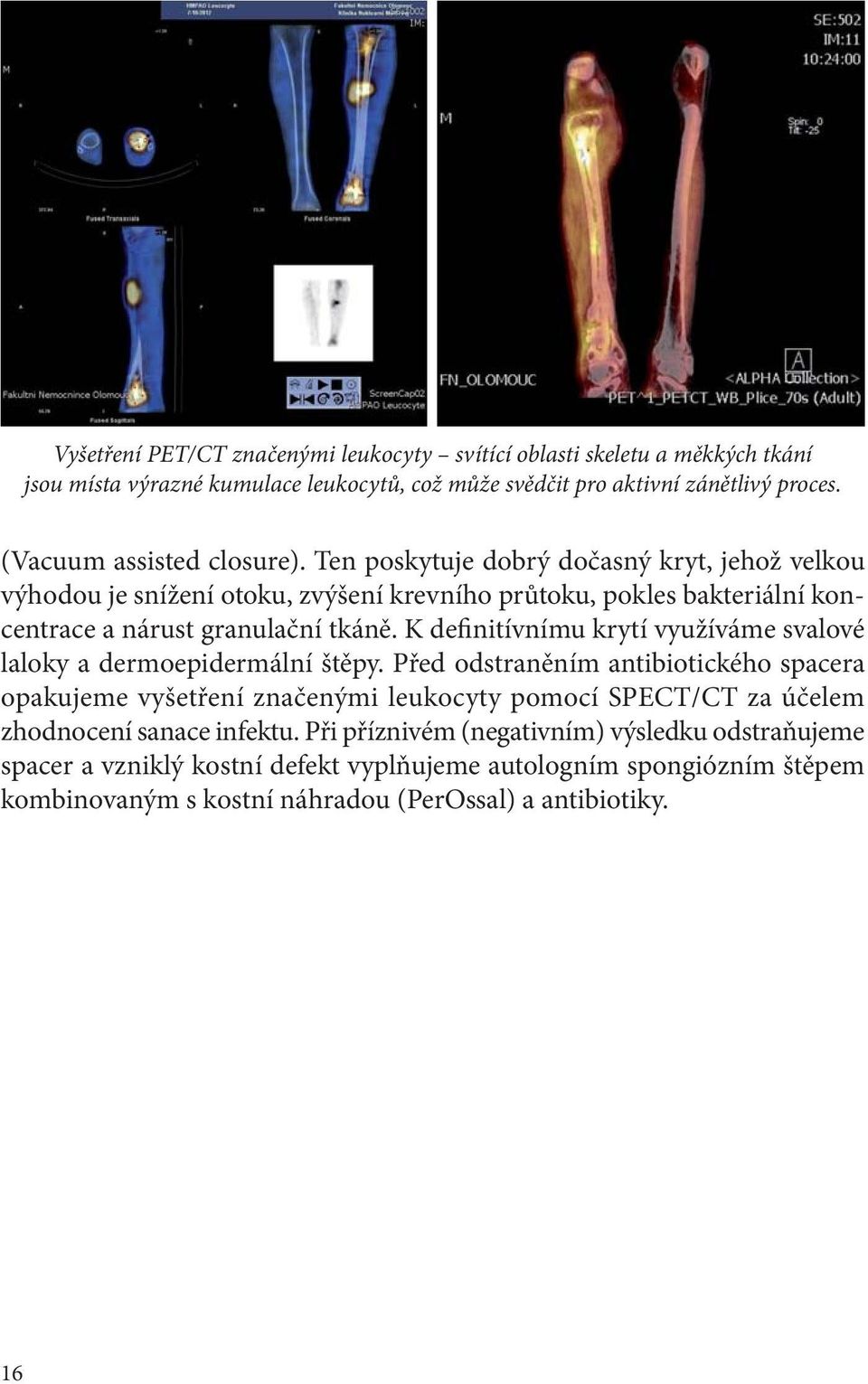 K definitívnímu krytí využíváme svalové laloky a dermoepidermální štěpy.