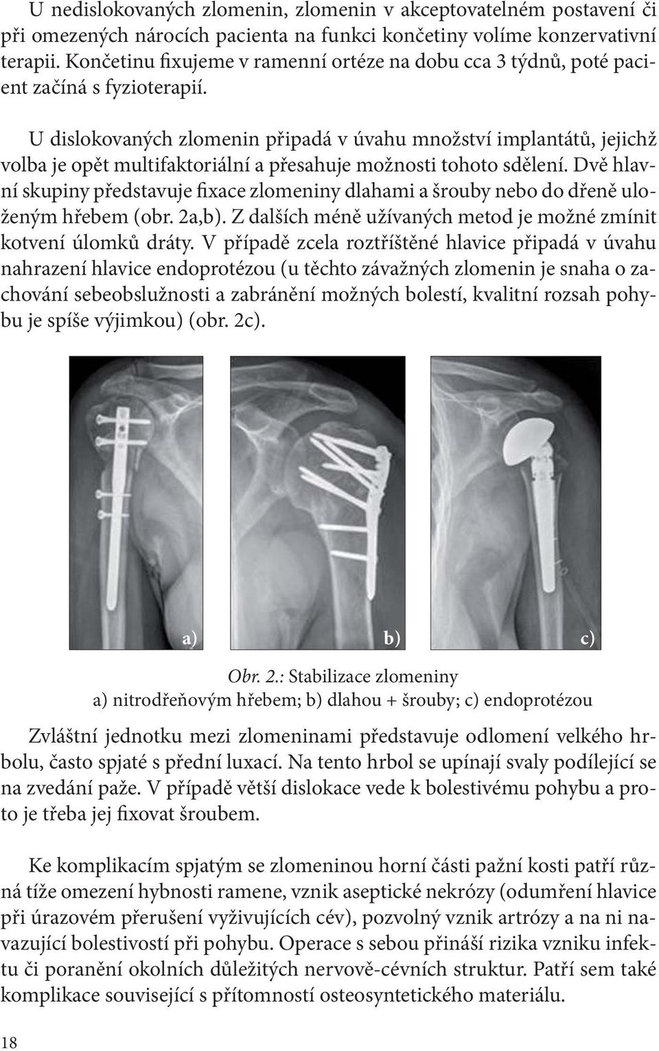 U dislokovaných zlomenin připadá v úvahu množství implantátů, jejichž volba je opět multifaktoriální a přesahuje možnosti tohoto sdělení.