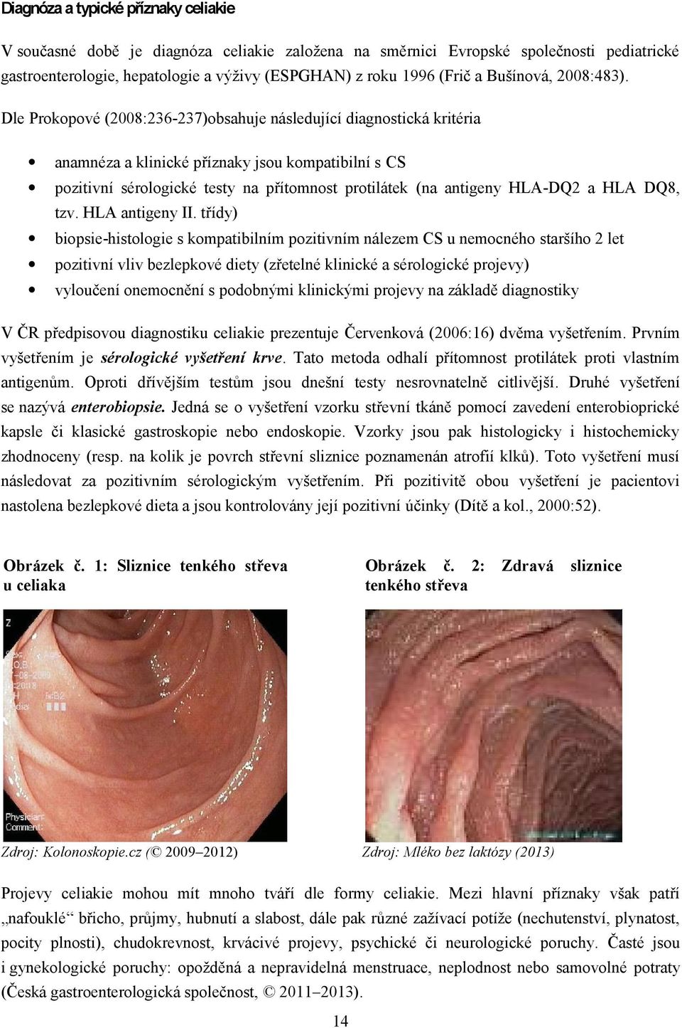 Dle Prokopové (2008:236-237)obsahuje následující diagnostická kritéria anamnéza a klinické příznaky jsou kompatibilní s CS pozitivní sérologické testy na přítomnost protilátek (na antigeny HLA-DQ2 a