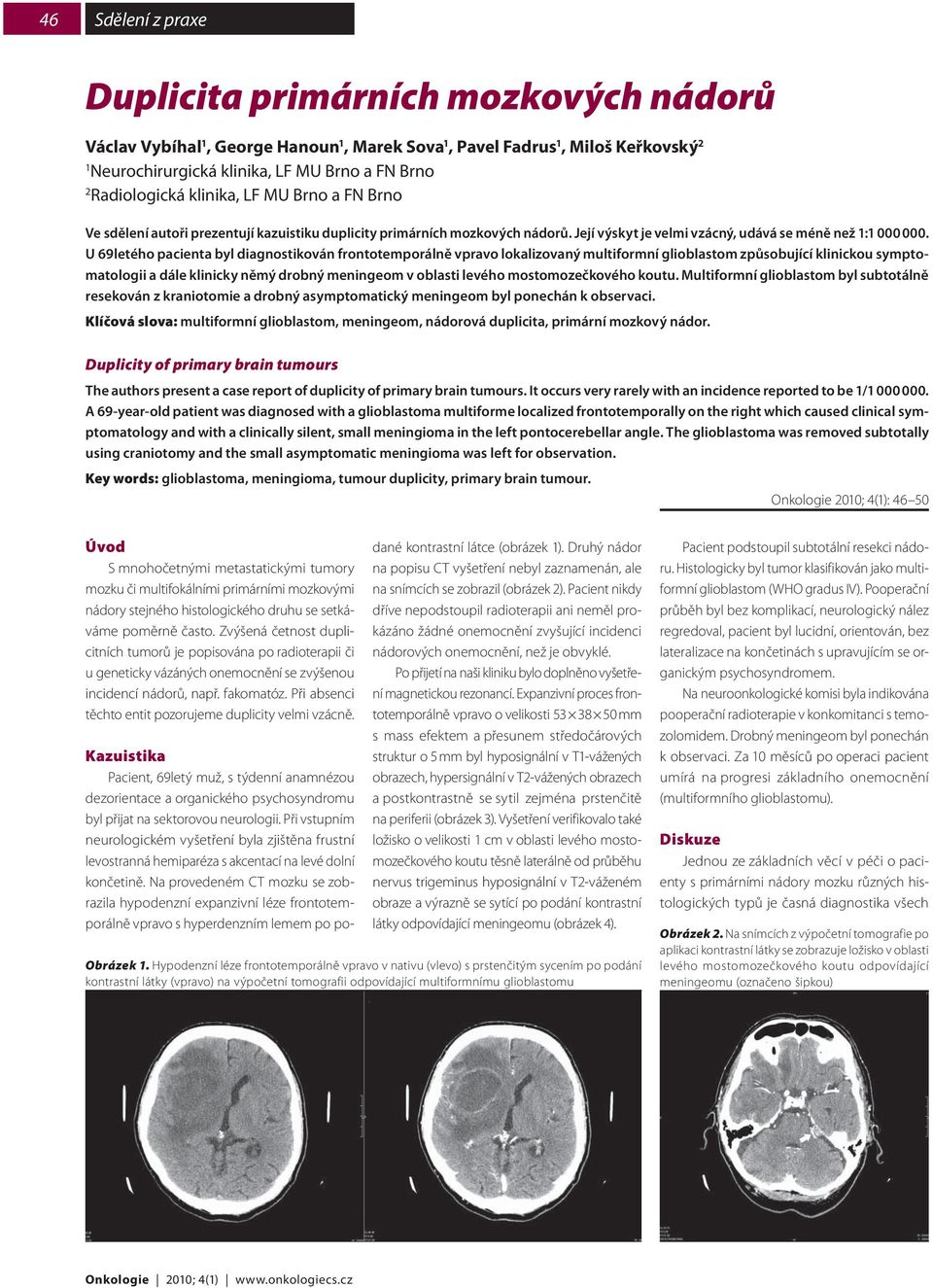 U 69letého pacienta byl diagnostikován frontotemporálně vpravo lokalizovaný multiformní glioblastom způsobující klinickou symptomatologii a dále klinicky němý drobný meningeom v oblasti levého