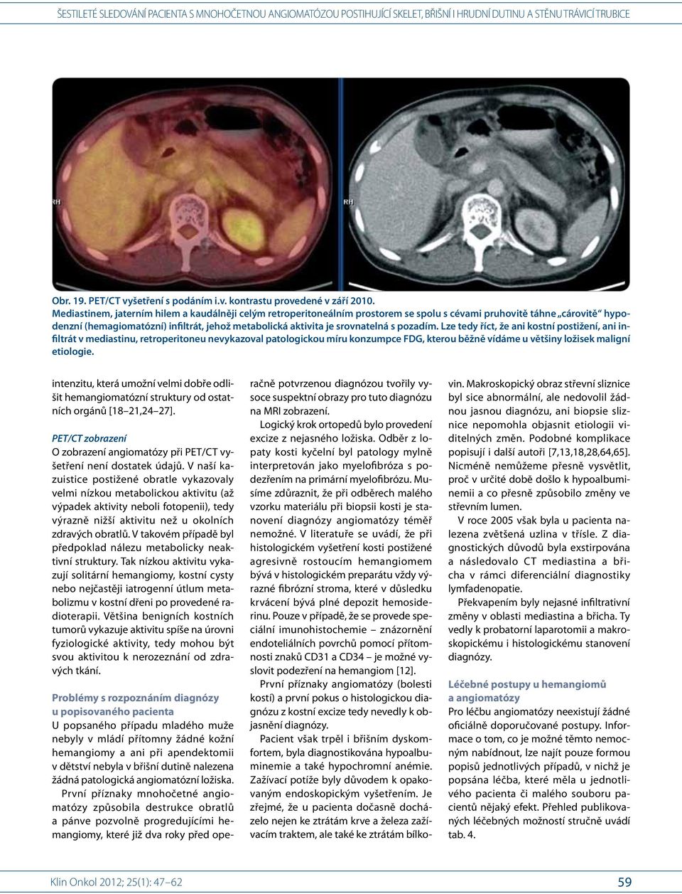 s pozadím. Lze tedy říct, že ani kostní postižení, ani infiltrát v mediastinu, retroperitoneu nevykazoval patologickou míru konzumpce FDG, kterou běžně vídáme u většiny ložisek maligní etiologie.