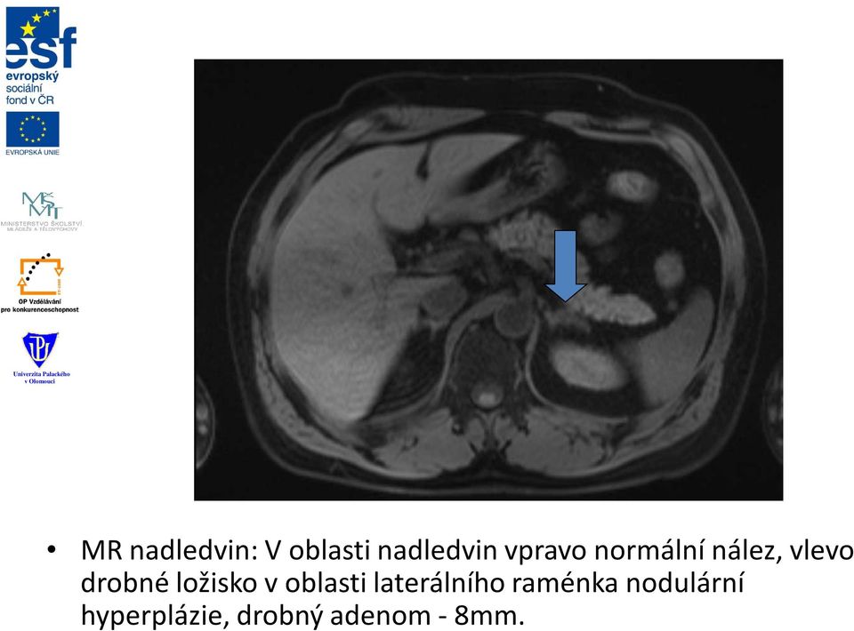 ložisko v oblasti laterálního raménka