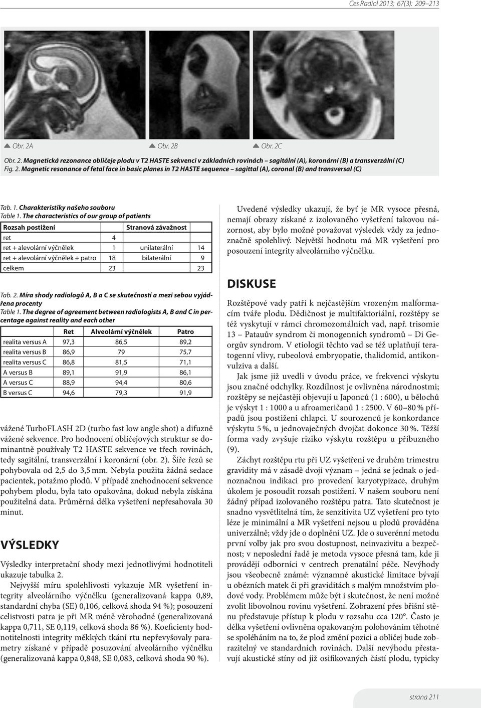 The characteristics of our group of patients Rozsah postižení Stranová závažnost ret 4 ret + alevolární výčnělek 1 unilaterální 14 ret + alevolární výčnělek + patro 18 bilaterální 9 celkem 23 23 Tab.