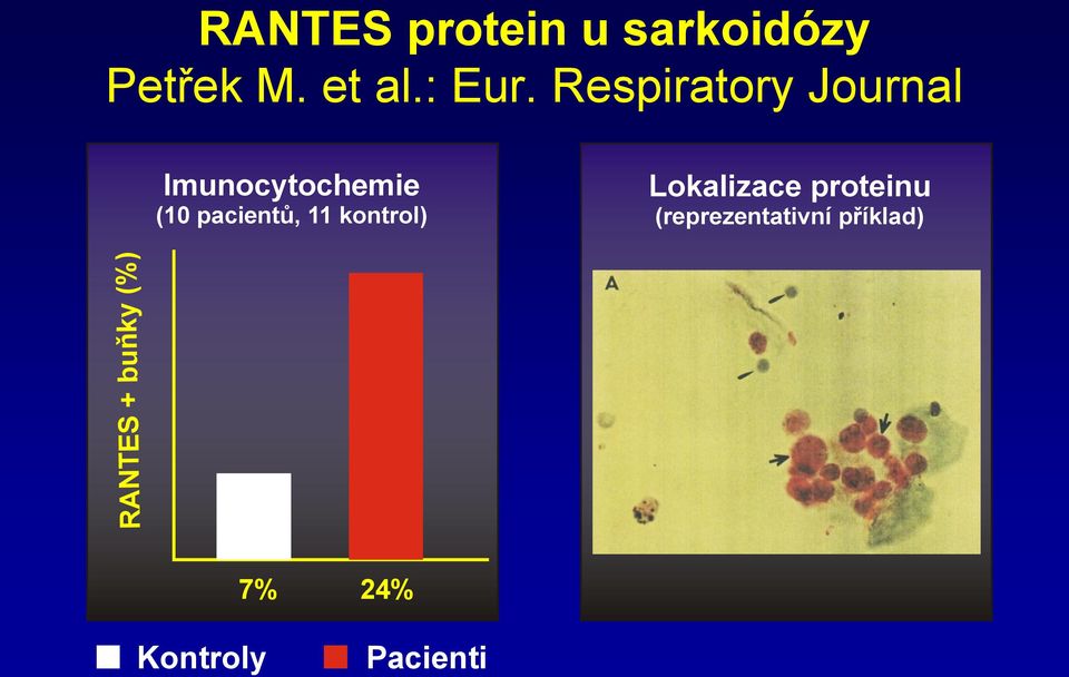 Respiratory Journal Imunocytochemie (10 pacientů,