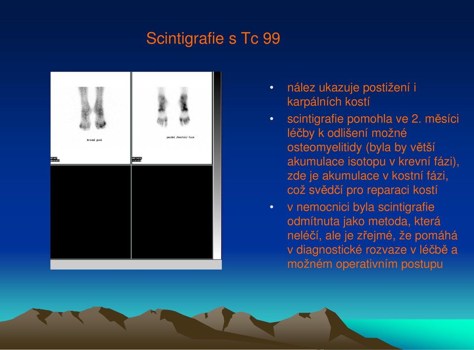 je akumulace v kostní fázi, což svědčí pro reparaci kostí v nemocnici byla scintigrafie odmítnuta